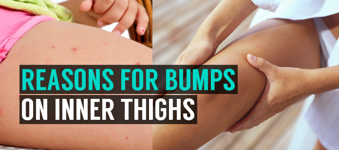 Learn Reasons For Painful Bumps On Inner Thighs Treatment