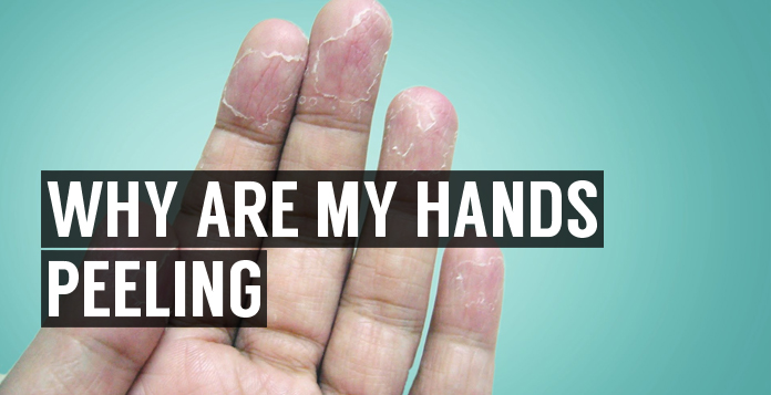 Why Are My Hands Peeling Myhealthdosage