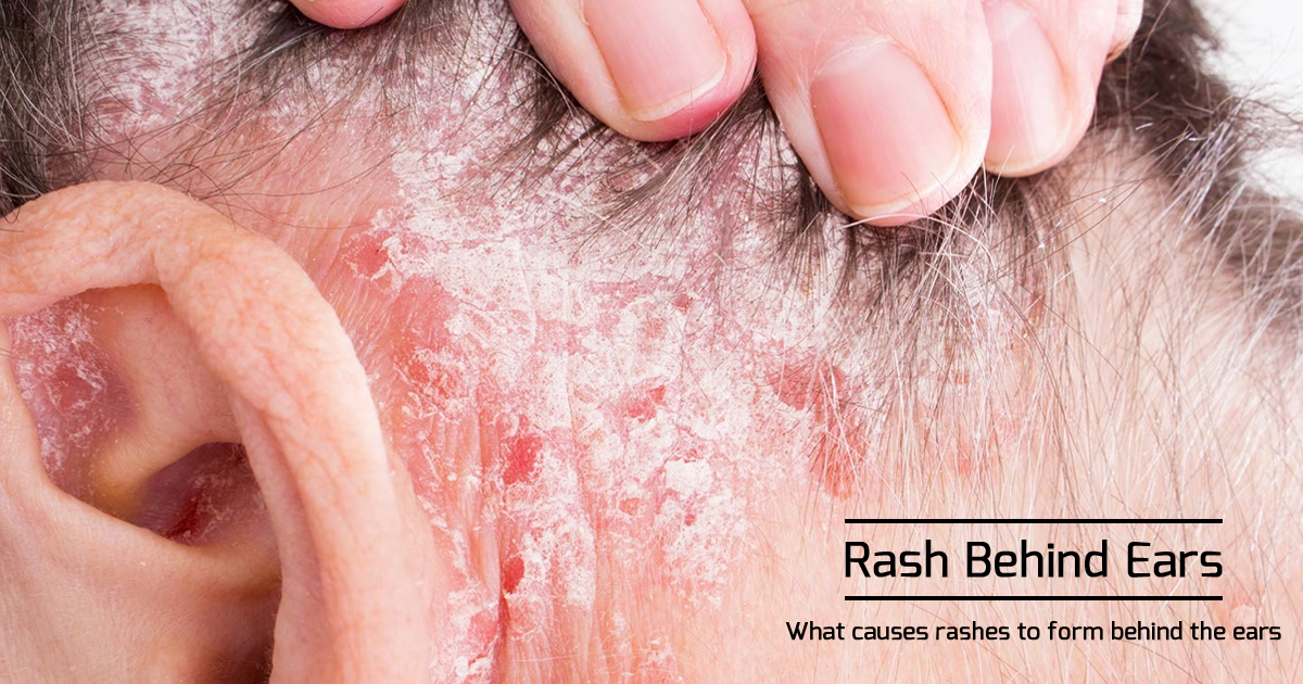 Rash Behind The Ear Causes Other Symptoms Of Rash On Neck Ears