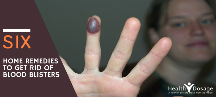 how-to-deal-with-blood-blister-on-finger