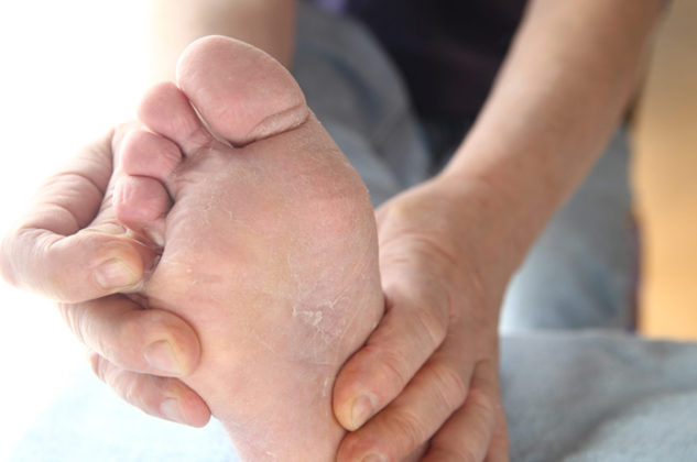 skin-peeling-between-foot-toes-possible-causes-effective-treatment