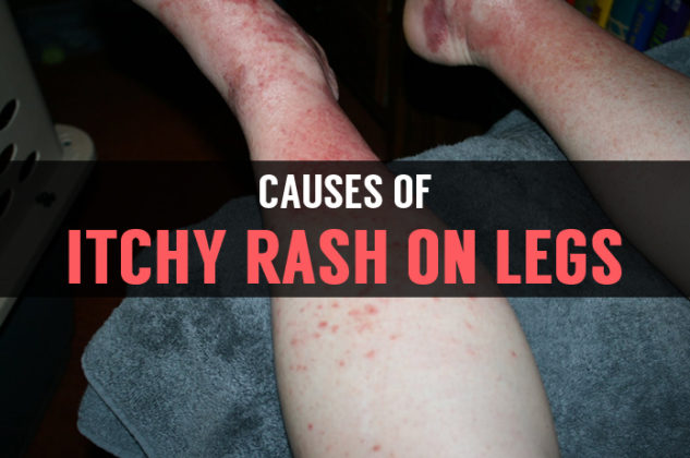 rash that get itchy when wet