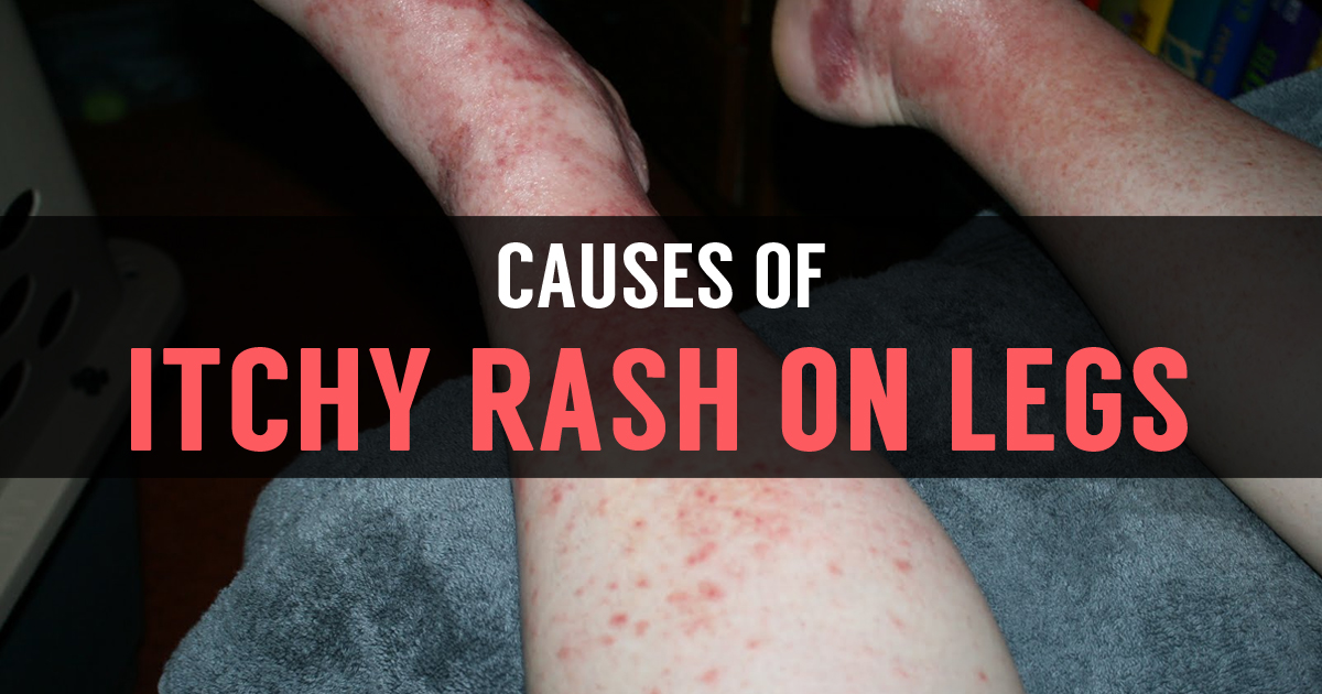 Itchy Rash On Legs What Causes Rashes On Skin Of Legs 