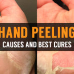 causes and best cures for hand peeling