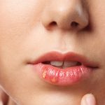 reasons and treatment for itchy bumps on lips