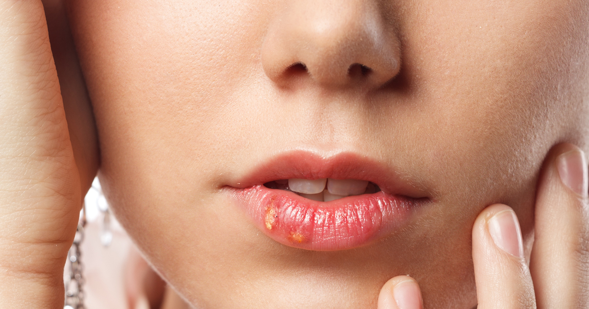 itchy-small-red-and-white-bumps-on-lips-reasons-treatment