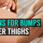 reasons for bumps on inner thighs