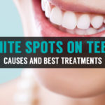 causes and best treatments for white spots on teeth