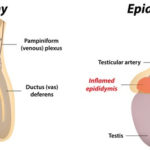 epididymitis