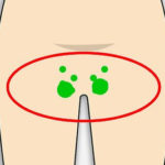 extended or swollen lymph glands