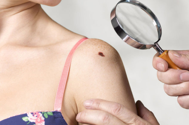 red-moles-on-skin-learn-causes-how-to-remove-red-moles