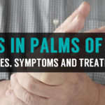 treatment for knots in palms of hand