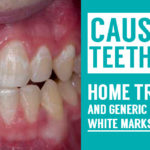 treatments and generic reasons for white marks on teeth