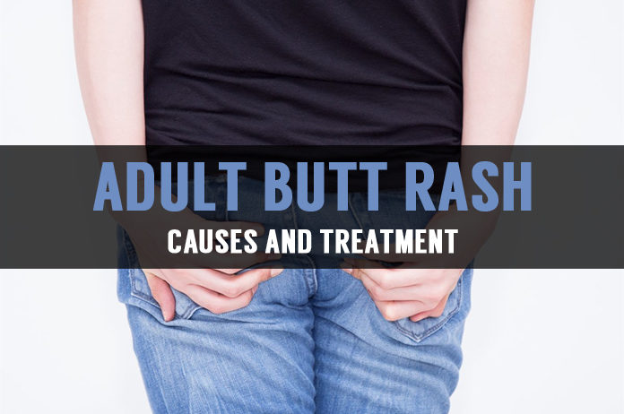 Learn About Adult Butt Rash And Its Treatment