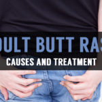 causes and treatment for adult butt rash