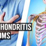 costochondritis symptoms