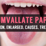 definition causes and treatment for enlarged circumvallate papillae