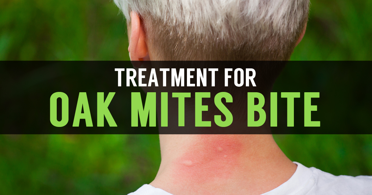 Oak Mites Treatment and Signs of Mite Bites