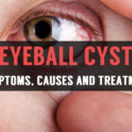 reasons and treatment for eyeball cyst