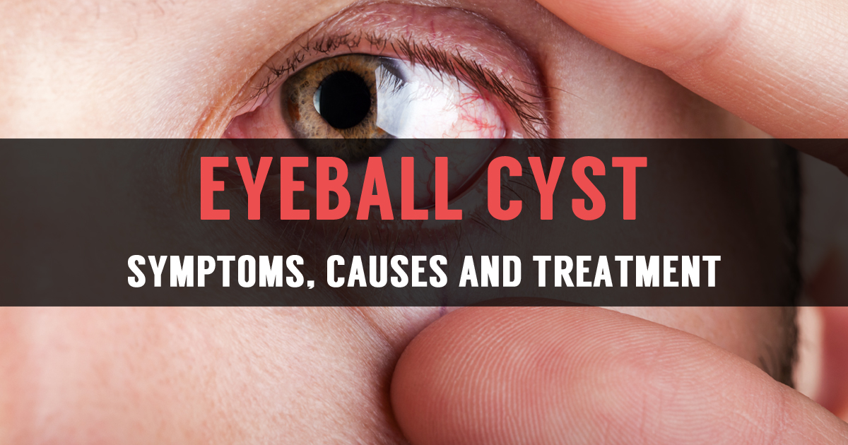 learn-reasons-for-eyeball-cyst-and-its-treatment