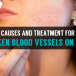 causes and treatment for broken blood vessels on face