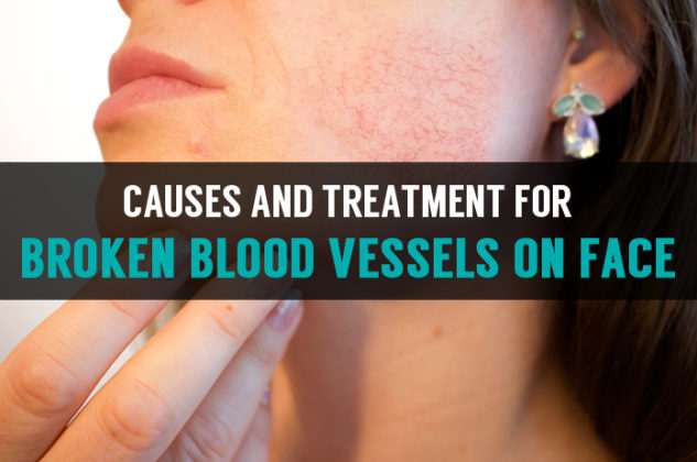 causes-and-treatment-for-broken-blood-vessels-on-face