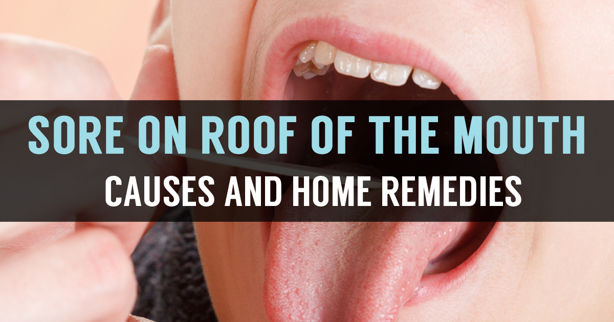 What Is Roof Of The Mouth Sore Know Its Causes Remedies