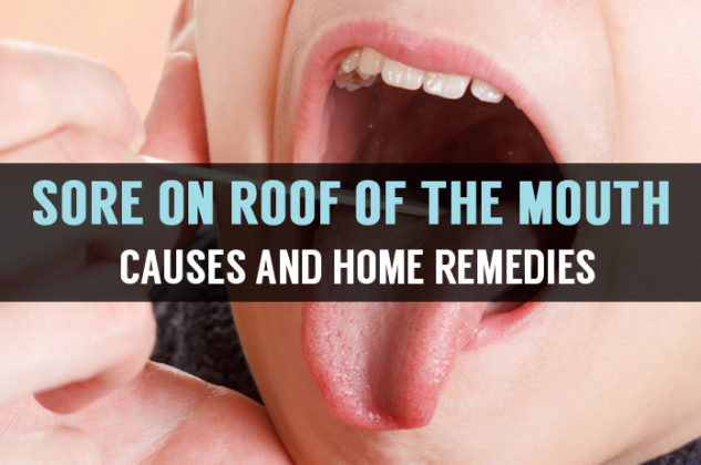 what-is-roof-of-the-mouth-sore-know-its-causes-remedies