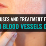 symptoms and remedies broken blood vessels on the face