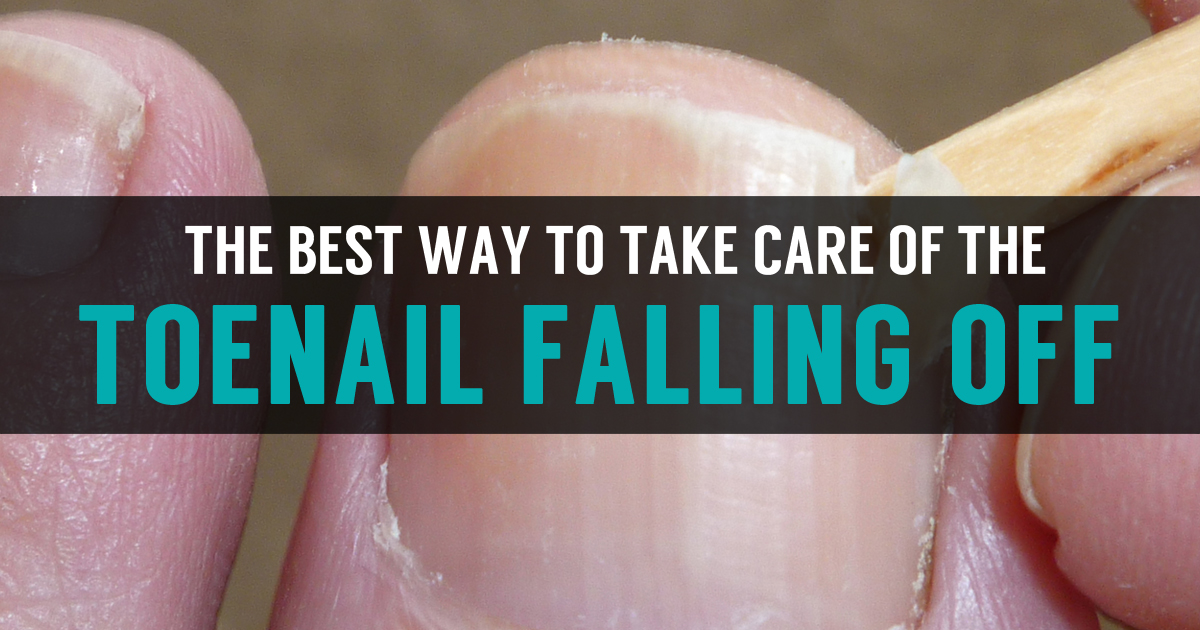 Toenail Falling Off Learn Best Treatment And Causes