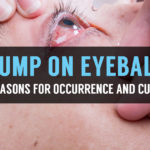 bump on the eyeball causes and treatment