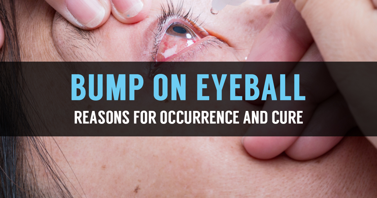 bump-on-eyeball-reasons-for-occurrence-and-cure