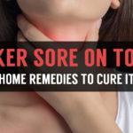 canker sore on tonsil causes remedies