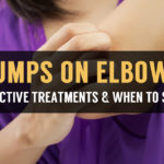 causes and effective treatments bumps on elbows