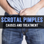 causes and treatment for scrotal pimples