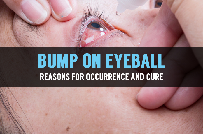 bump-on-eyeball-reasons-for-occurrence-and-cure