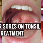 home remedies for canker sores on tonsil and throat