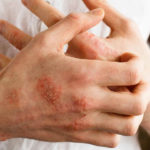 essential oils for treatment of eczema