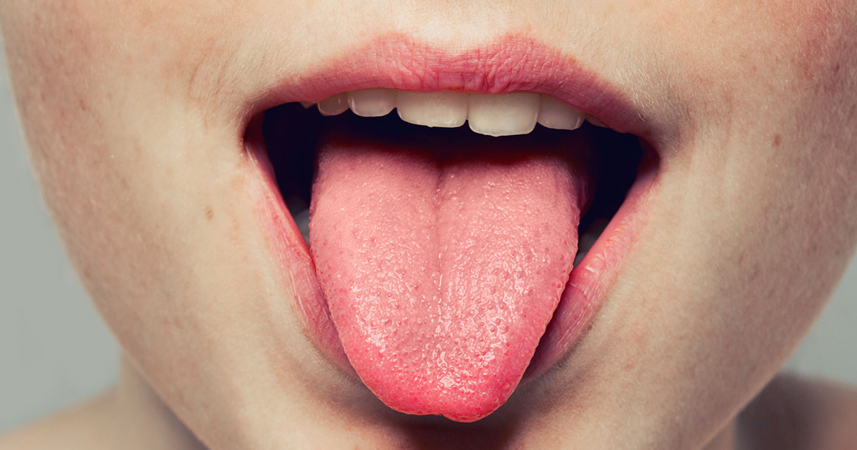 Swollen Taste Buds Learn How Long Do Swollen Taste Buds Last