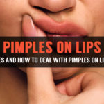 pimples on lips and how to deal with it