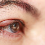 treatments and causes for white bump on eyelid