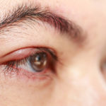 what causes white bump around the eyelid