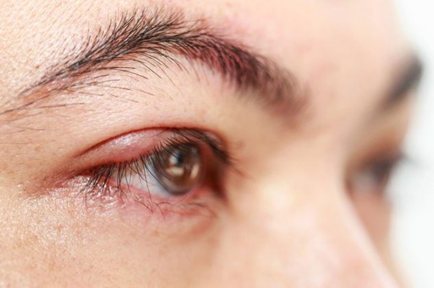 What Causes White Bump on Eyelid? Easy Tips and Treatment Advice