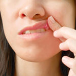 canker sore on gum tissue