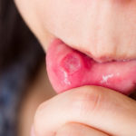 how to use essential oils for canker sores