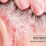 main causes for rash behind ears