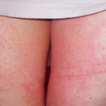 rash on inner thigh symptoms causes and treatments