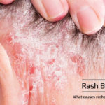 what causes rashes to form behind the ears