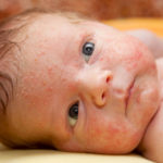 what is eczema in babies and how to get rid of it