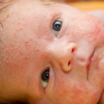 what is eczema in babies children and teenagers